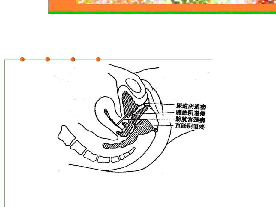 专科尿宫脱垂_第4页