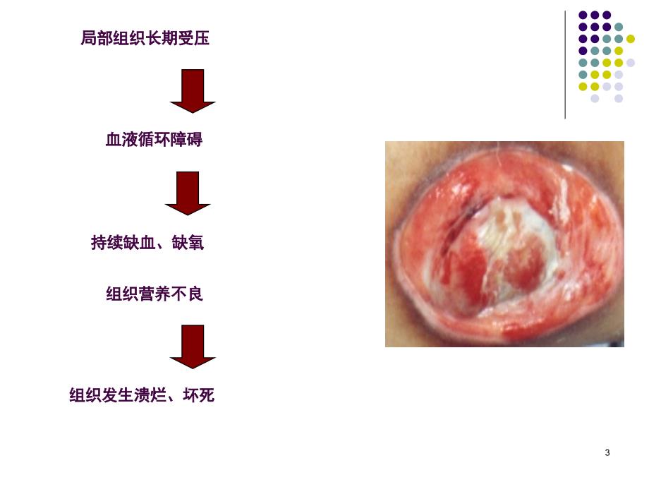 压疮预防及护理ppt课件_第3页