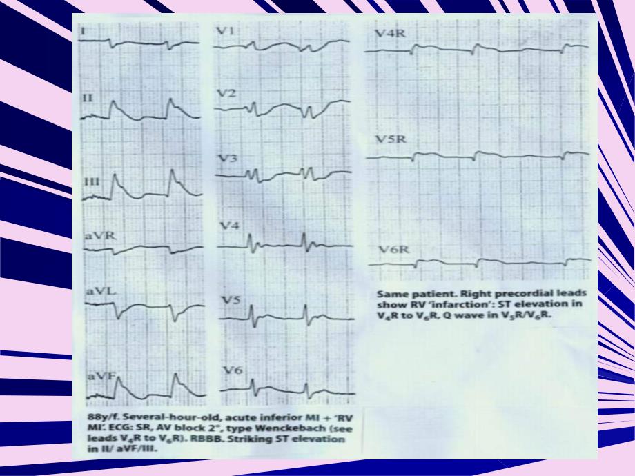 急性心肌梗死ami临床诊断存在的几个问题ppt课件_第4页