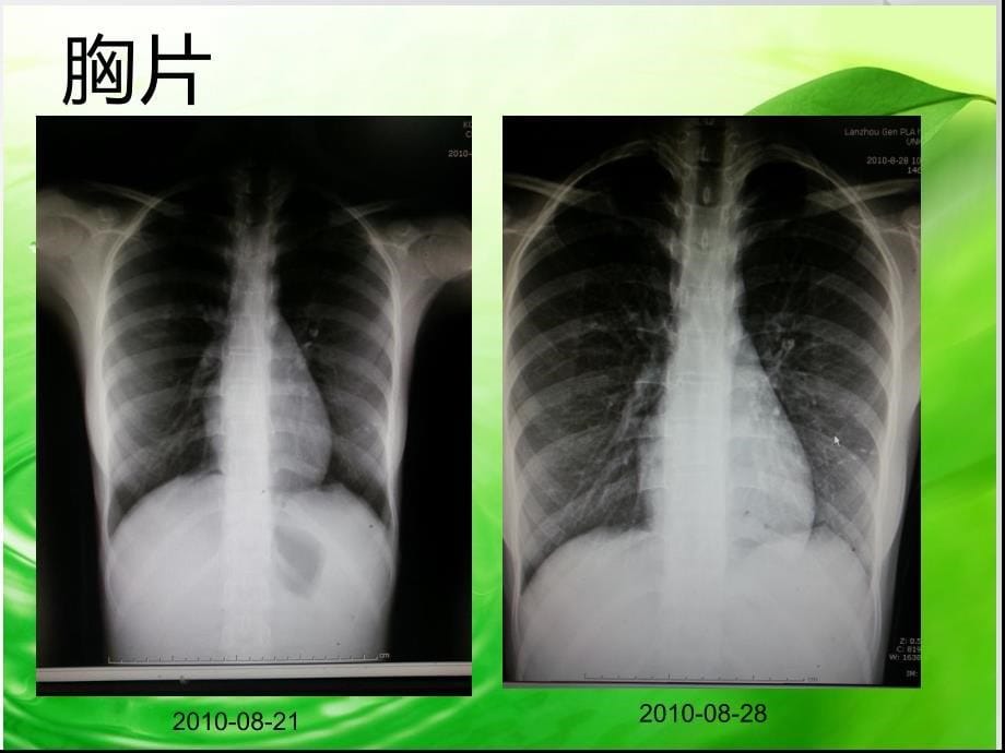 感染性心内膜炎致急性心肌梗死ppt课件.ppt_第5页