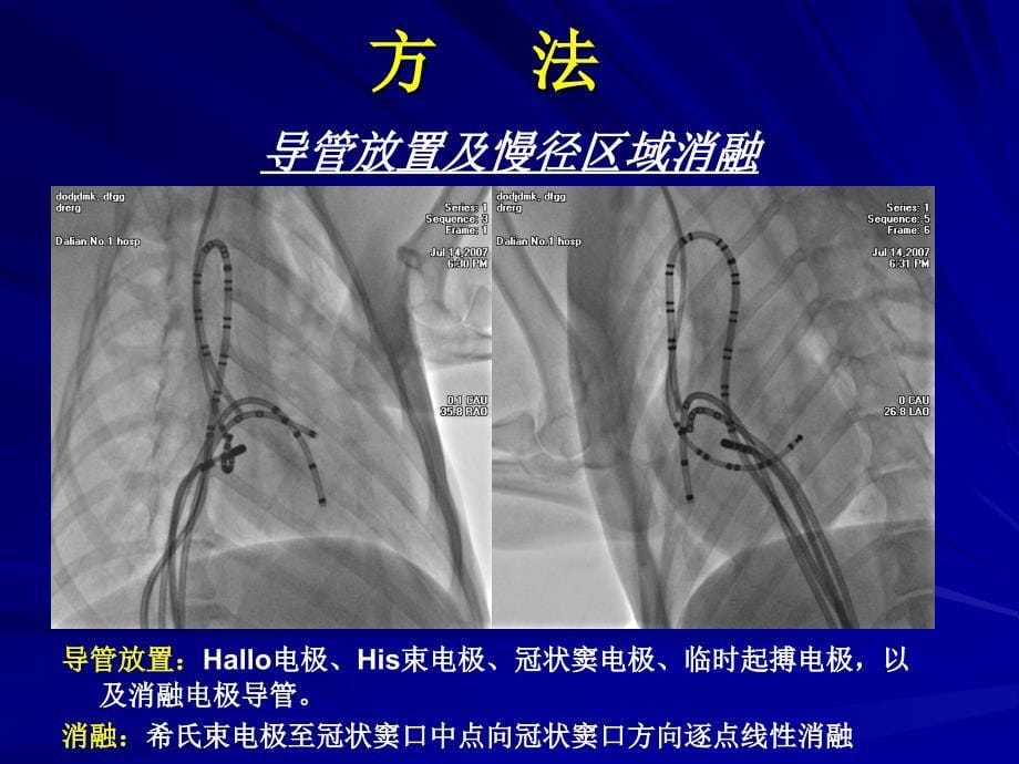 慢径区域消融对迷走神经功能的影响_第5页