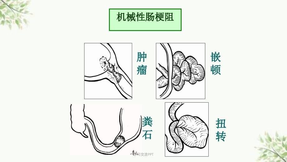 肠梗阻病人的护理 最新医学PPT课件_第5页