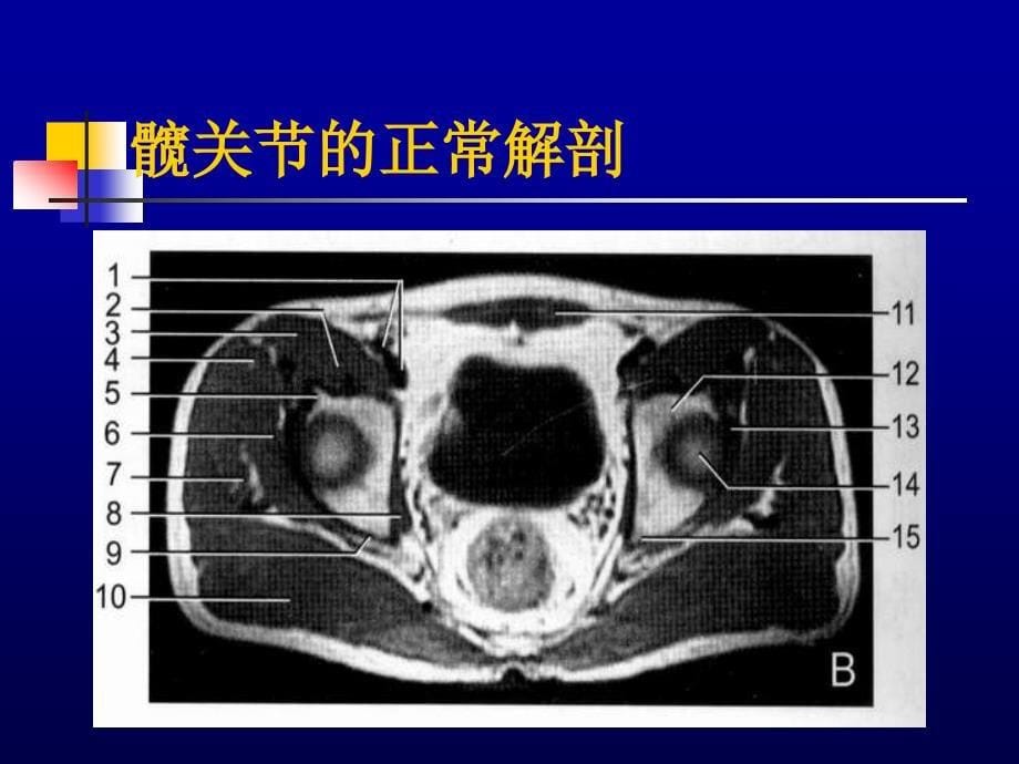 髋关节mrippt课件_第5页