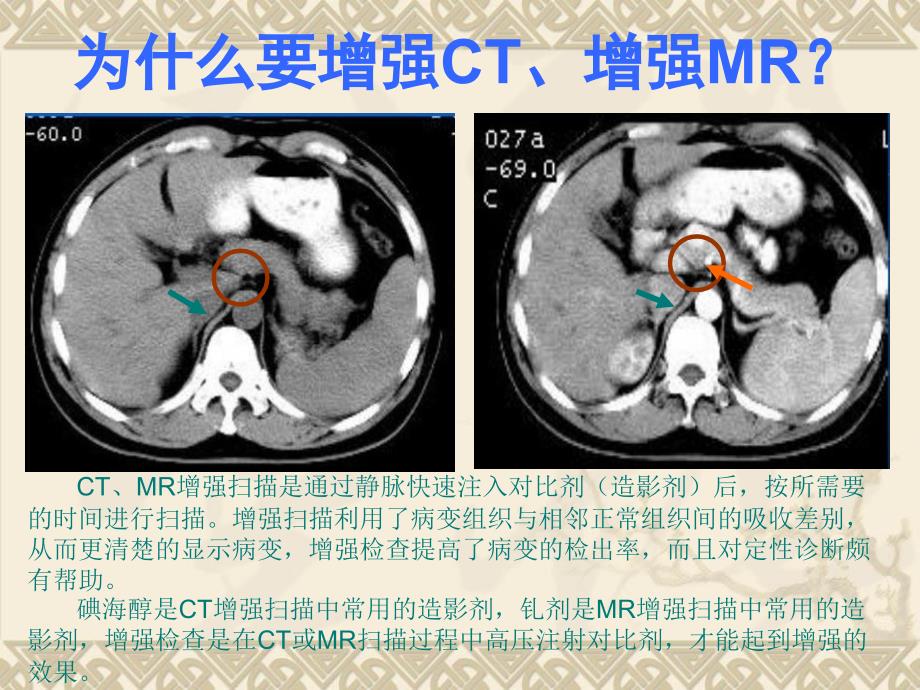 造影剂对比剂外渗预防与处理_第3页