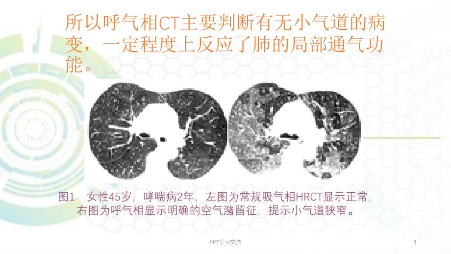 肺部病变的CT表现医学PPTppt课件_第4页