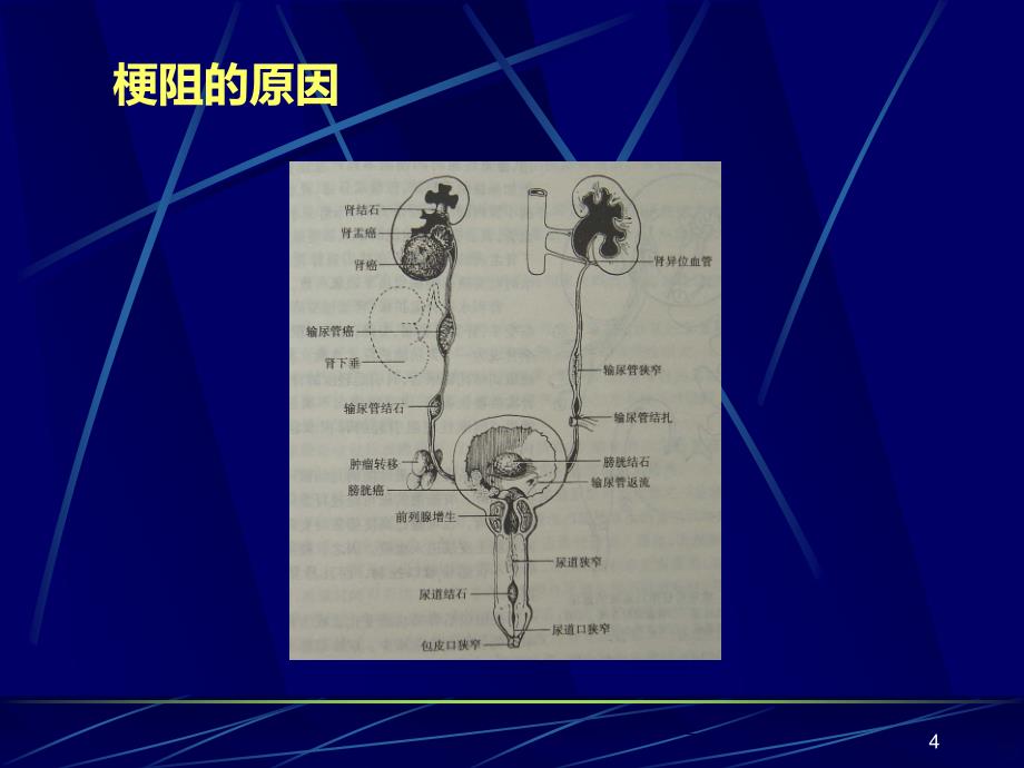 泌尿系统梗阻PPT课件.ppt_第4页