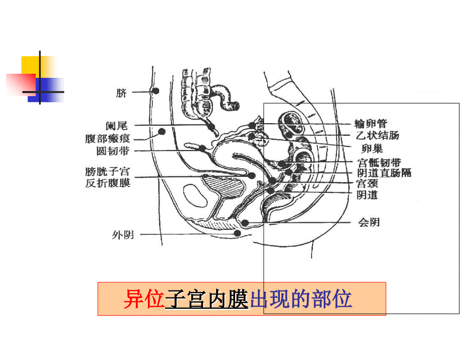 妇产科子宫内膜异位症_第4页