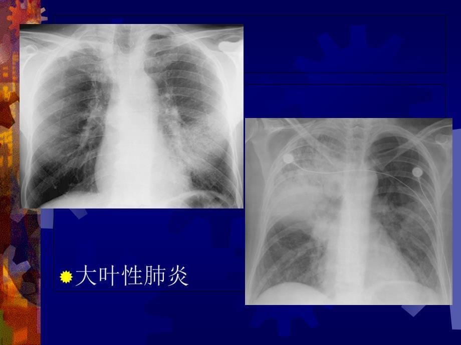 《肺炎CT表现》PPT课件_第5页