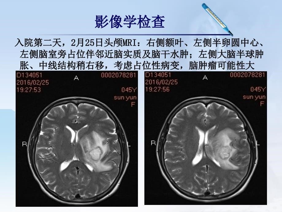 李旭PBC脑脓肿_第5页