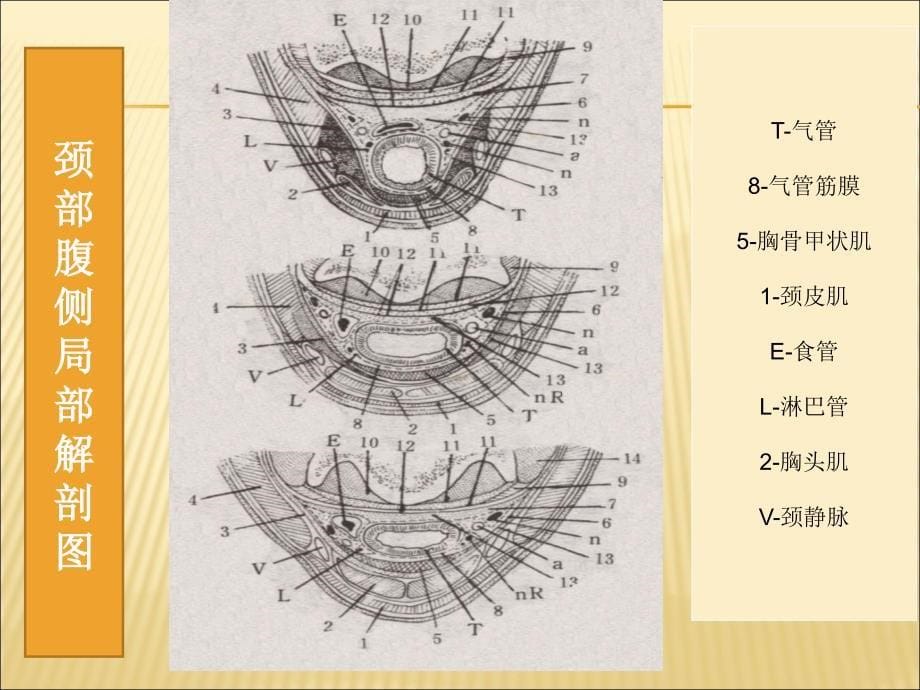 气管切开手术_第5页