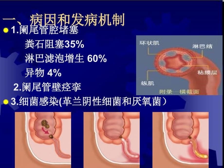 临床医学概要34阑尾炎溃疡穿孔_第5页