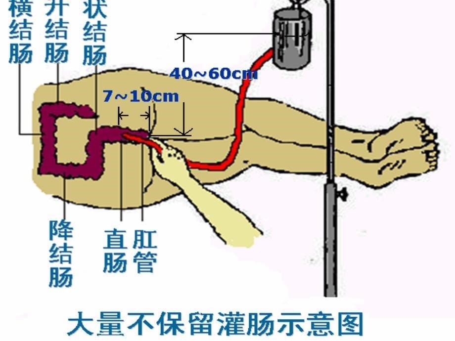 灌肠、肛管排气_第5页