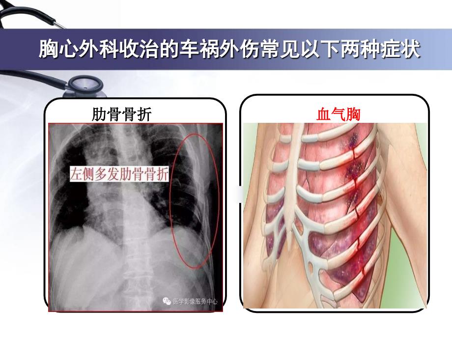 胸腔闭式引流术_第3页