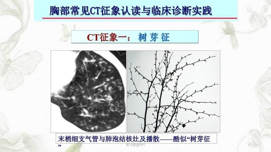 胸部常见CT十大征象的诊断及应用课件_第5页