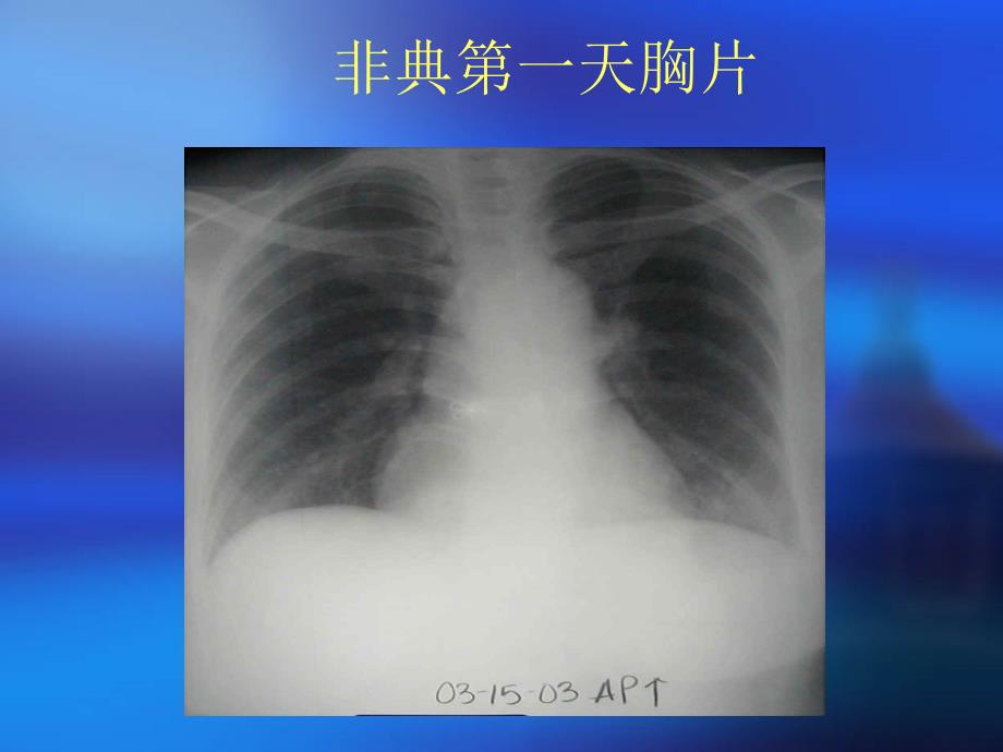 急性肺损伤和急性呼吸窘迫_第1页