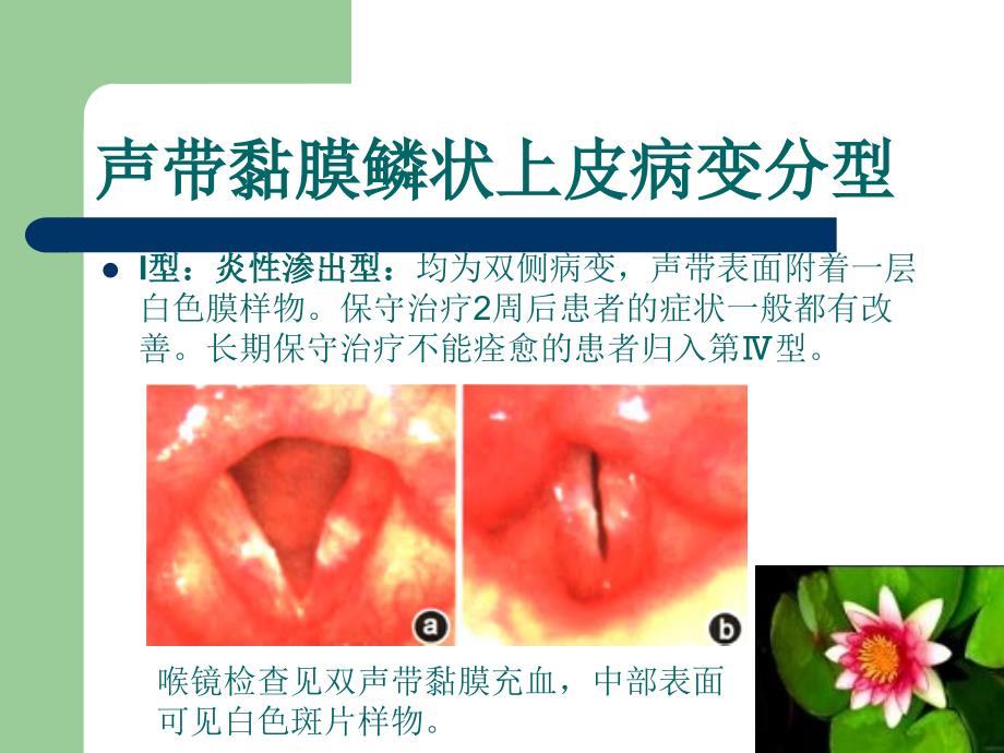 声带黏膜上皮病变临床特征与治疗_第3页