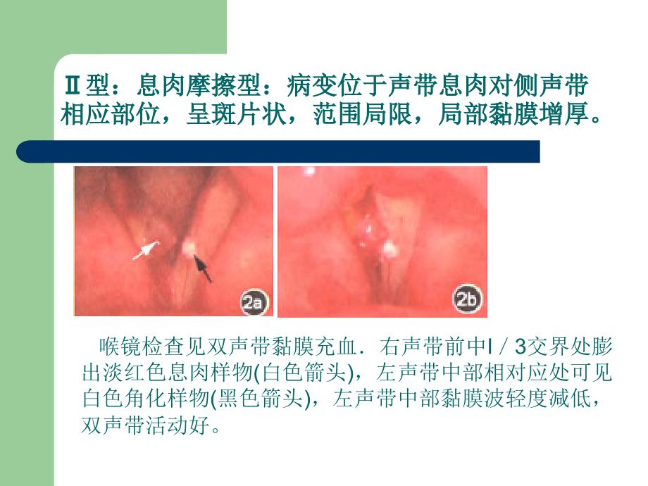 声带黏膜上皮病变临床特征与治疗_第4页