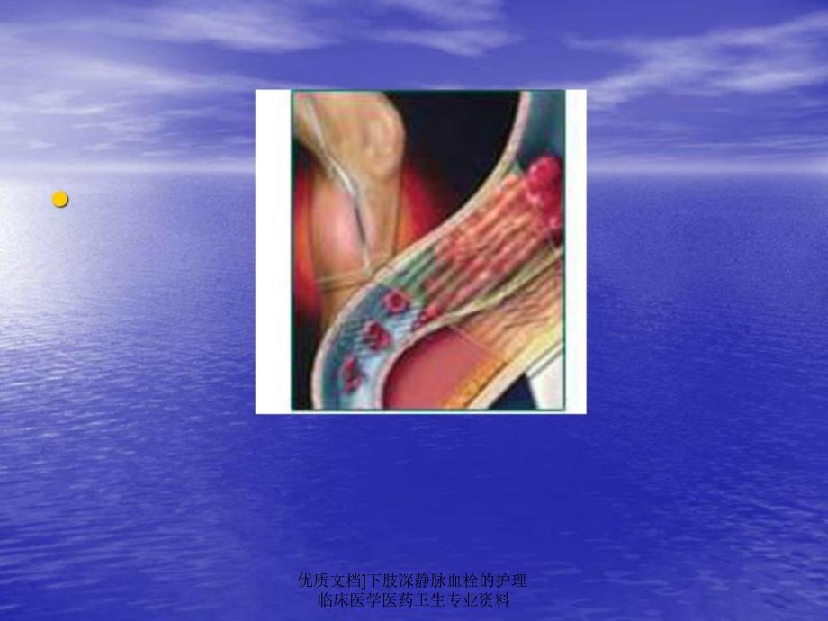 优质文档下肢深静脉血栓的护理临床医学医药卫生专业资料课件_第4页