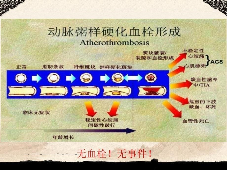 慢性心肌缺血综合症的诊断及治疗_第5页