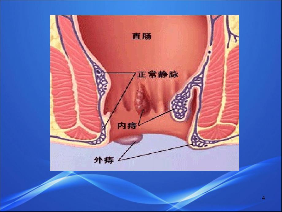 （精选课件）PPH术前术后护理_第4页