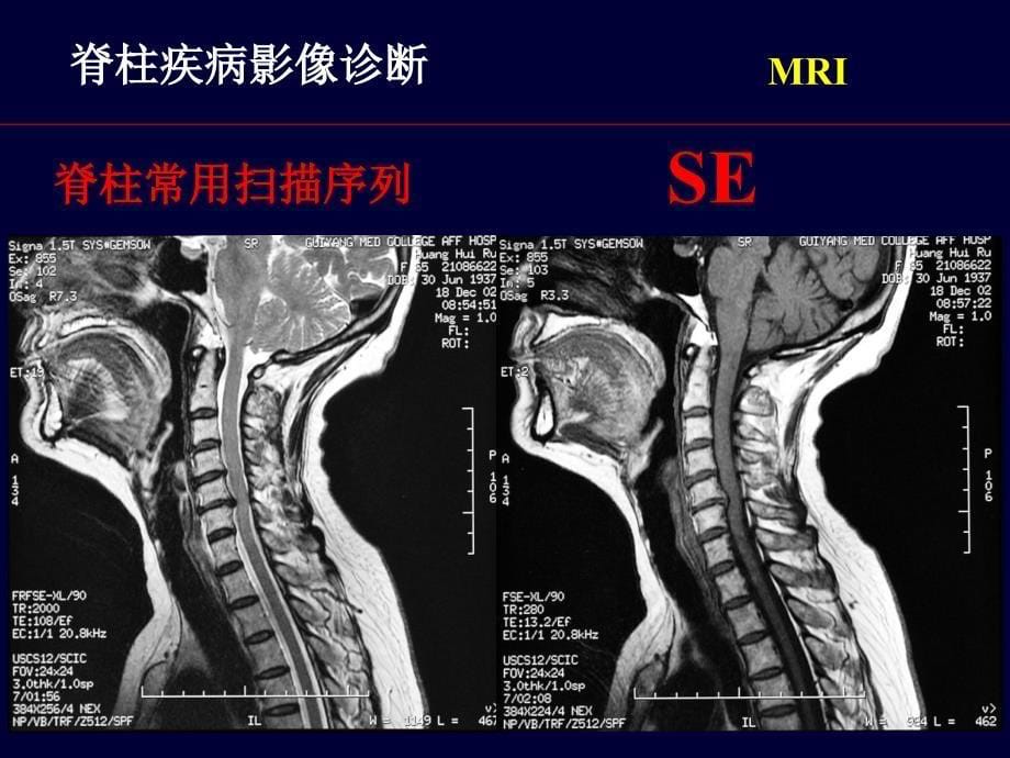 最新脊柱疾病MRI诊断_第5页