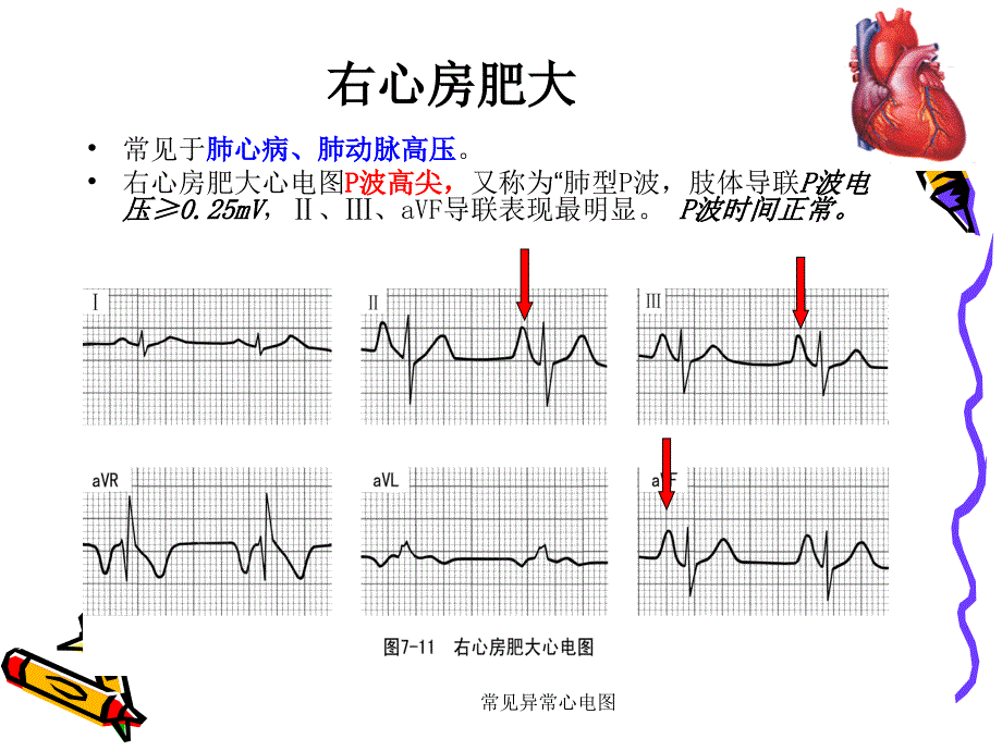 常见异常心电图课件_第3页