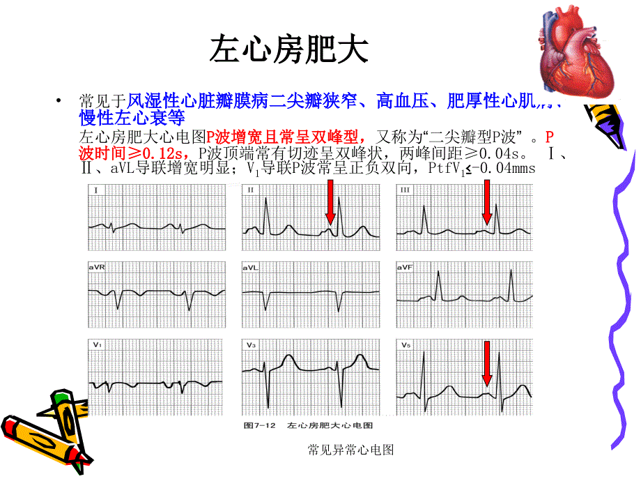 常见异常心电图课件_第4页