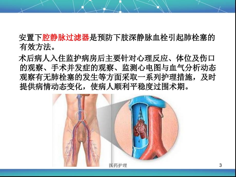 下腔静脉滤器植入术后护理【医疗知识】_第3页