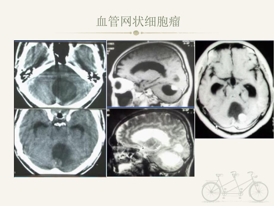 血管网状细胞瘤的CT表现_第4页