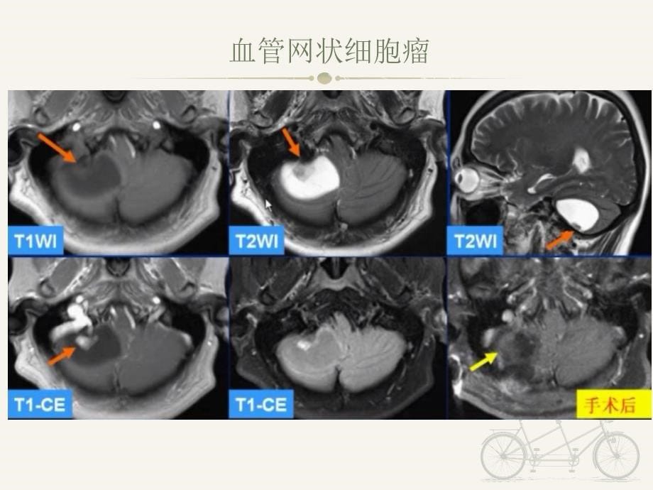 血管网状细胞瘤的CT表现_第5页