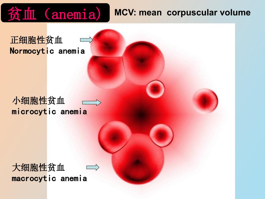 血液学缺铁性贫血_第3页