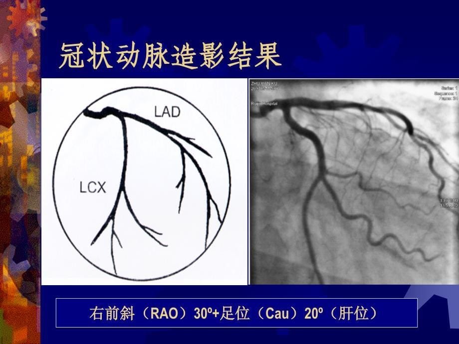 心脏介入治疗的简介.ppt_第5页