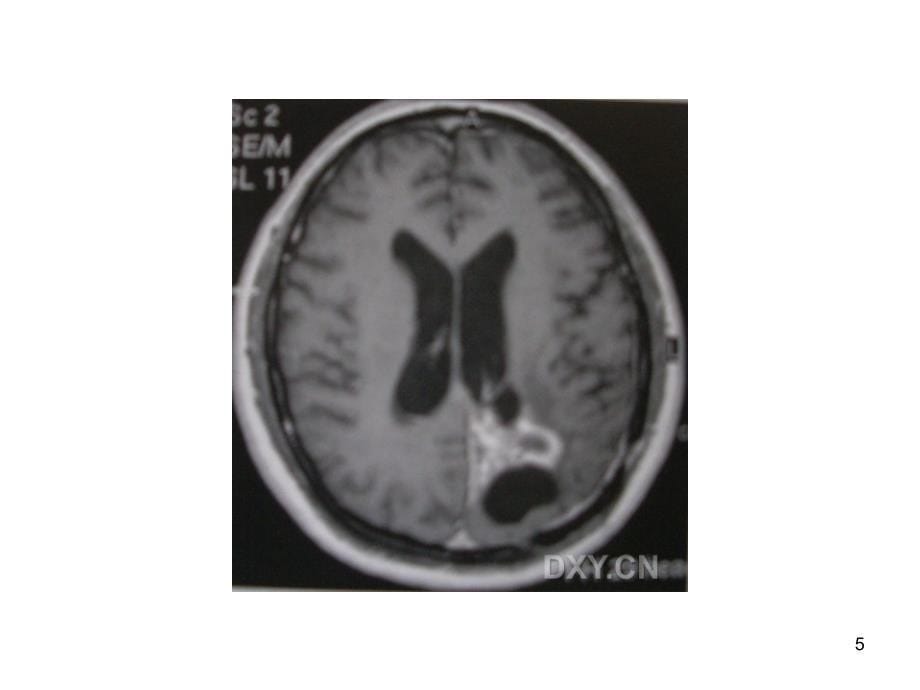 颅脑病变影像诊断ppt课件_第5页
