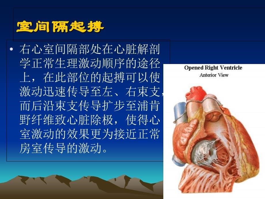 右心室间隔部起搏术的应用课件_第5页