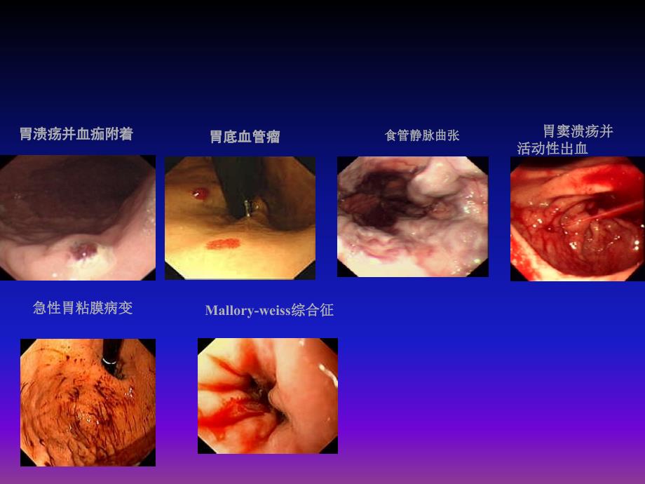 课件：消化道出血的诊治.ppt_第4页