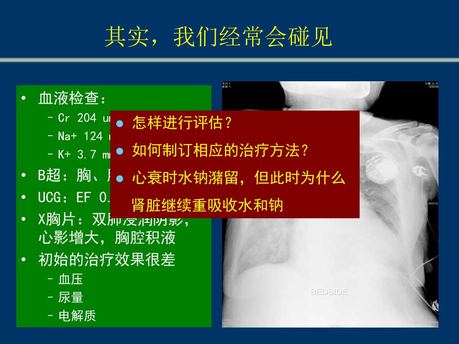 心力衰竭患者水过负荷与低钠血症课件幻灯ppt文档资料_第2页