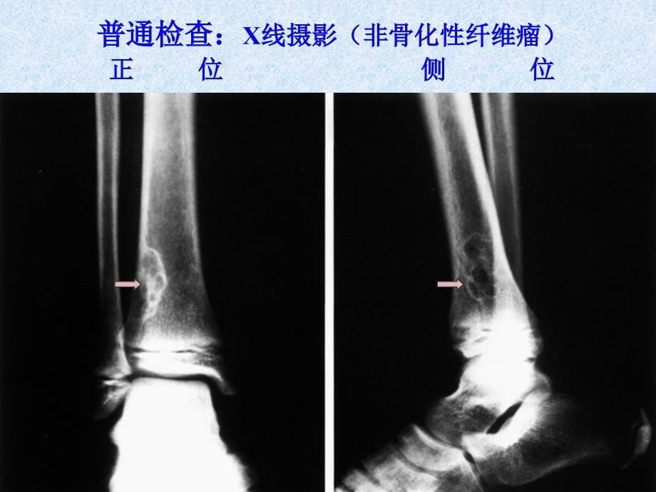 外科骨科骨关节系像诊断学_第5页