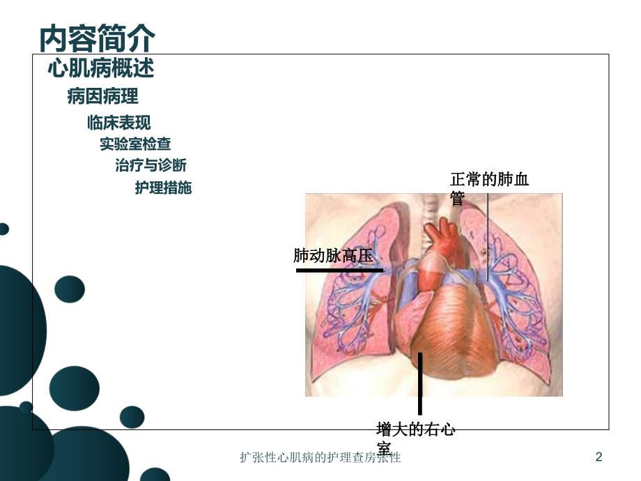 扩张性心肌病的护理查房张性课件_第2页