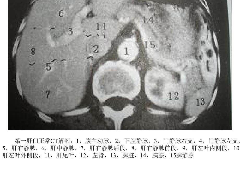 肝脏疾病影像学特点课件_第4页