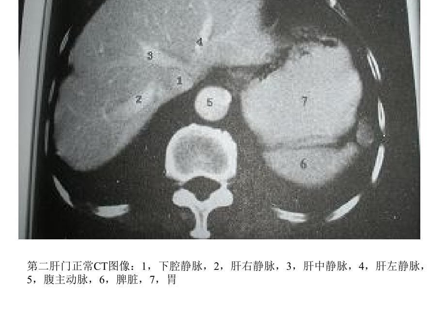 肝脏疾病影像学特点课件_第5页