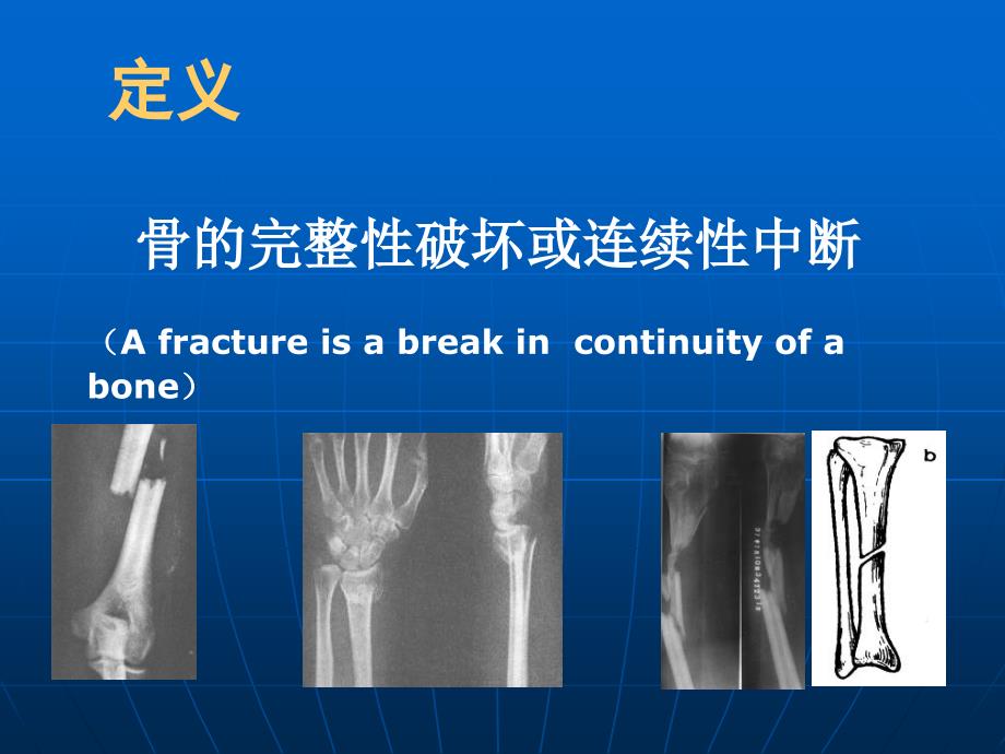 规培骨折固定技术课件_第3页