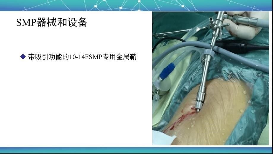 超微通道经皮肾镜碎石取石术.ppt_第5页