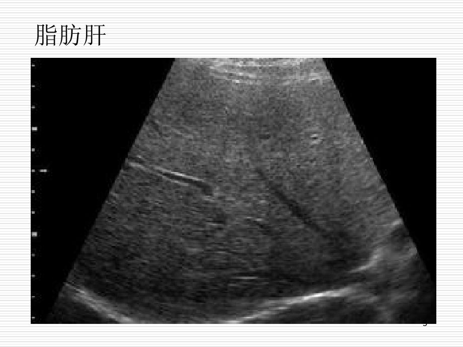 消化系疾病影像ppt课件_第3页