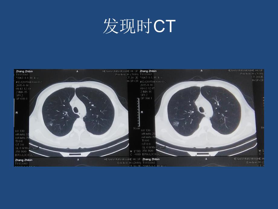 例肺ggn的诊疗历程_第3页