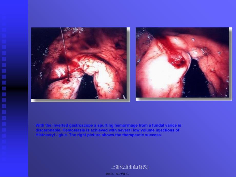上消化道出血修改课件_第4页