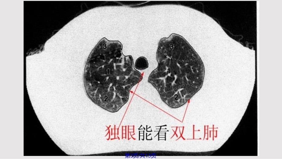 CT肺段定位口诀实用教案_第3页