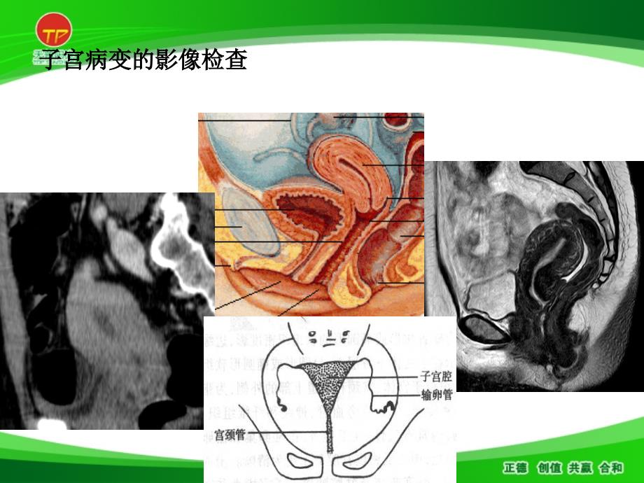 子宫恶性肿瘤的MR诊断_第2页