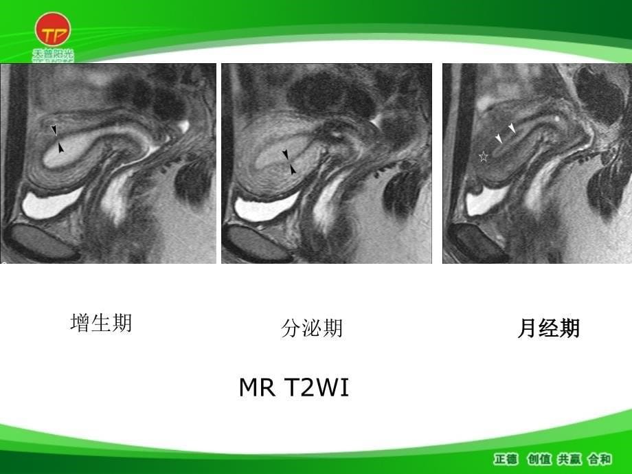 子宫恶性肿瘤的MR诊断_第5页