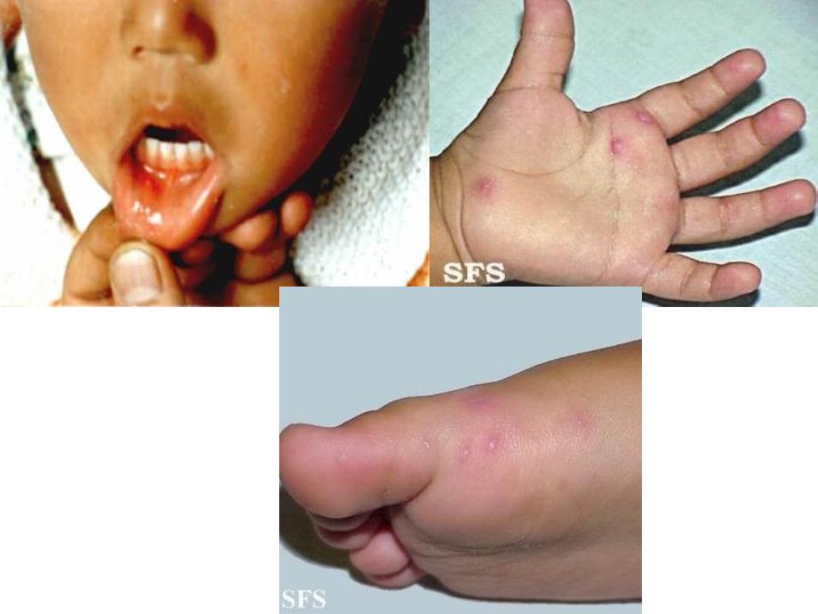 手足口病教学课件_第4页