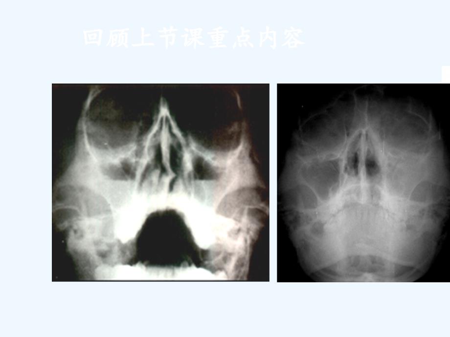 X线检查与诊断技术第四篇胸部一课件_第2页